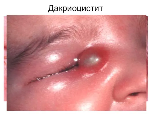 Дакриоцистит – воспаление слезного мешка в результате нарушения проходимости носослезного