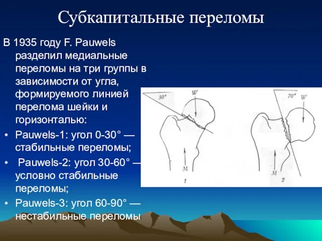 Субкапитальные переломы В 1935 году F. Pauwels разделил медиальные переломы