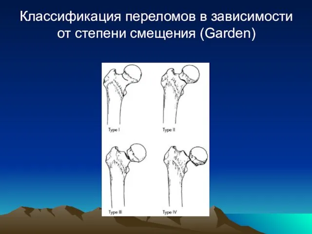 Классификация переломов в зависимости от степени смещения (Garden)