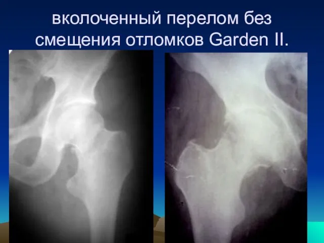 вколоченный перелом без смещения отломков Garden II.