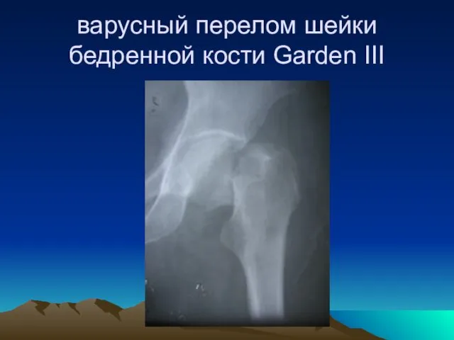 варусный перелом шейки бедренной кости Garden III