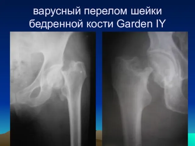 варусный перелом шейки бедренной кости Garden IY