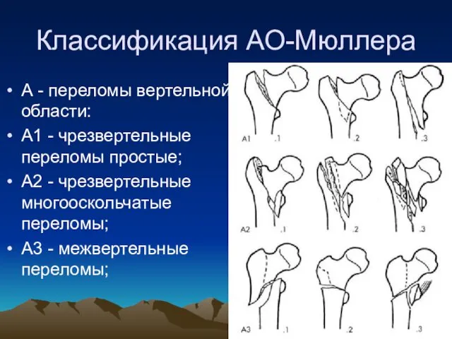 Классификация АО-Мюллера А - переломы вертельной области: А1 - чрезвертельные