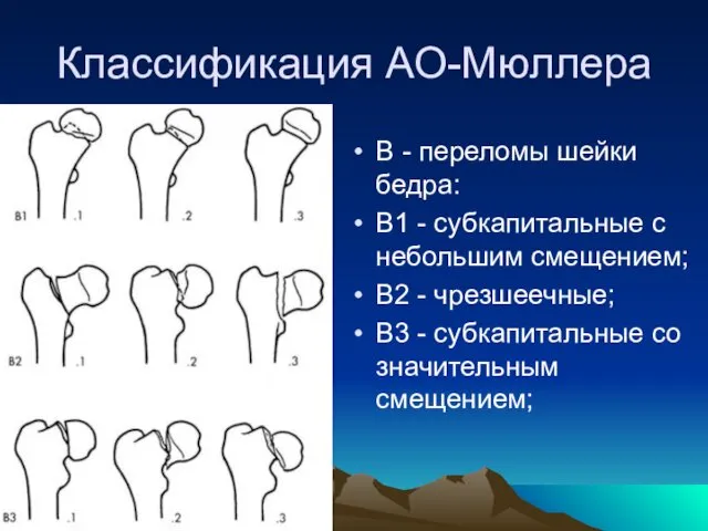 Классификация АО-Мюллера В - переломы шейки бедра: В1 - субкапитальные