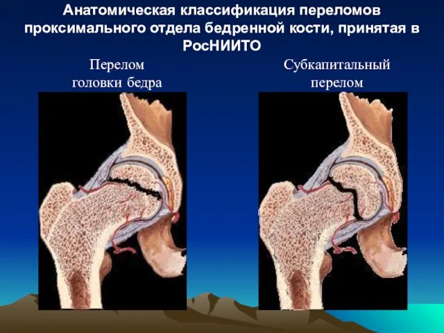 Перелом головки бедра Субкапитальный перелом Анатомическая классификация переломов проксимального отдела бедренной кости, принятая в РосНИИТО