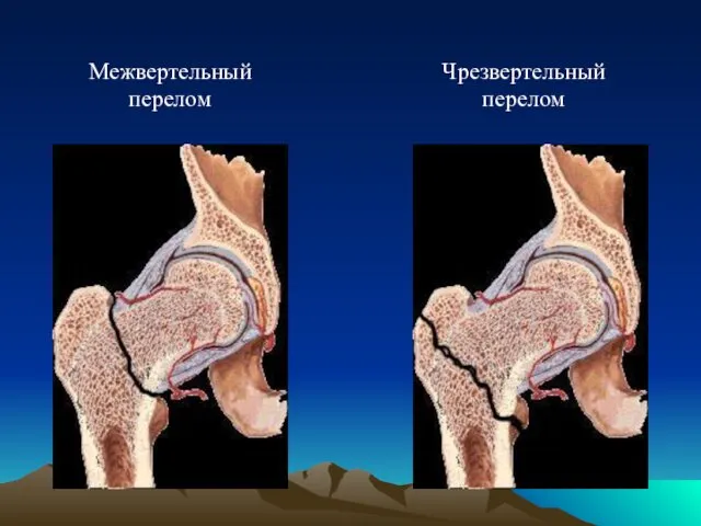 Межвертельный перелом Чрезвертельный перелом