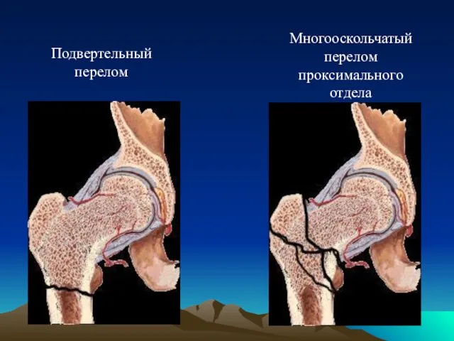 Подвертельный перелом Многооскольчатый перелом проксимального отдела