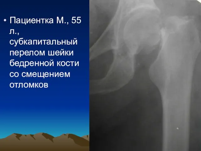 Пациентка М., 55 л., субкапитальный перелом шейки бедренной кости со смещением отломков