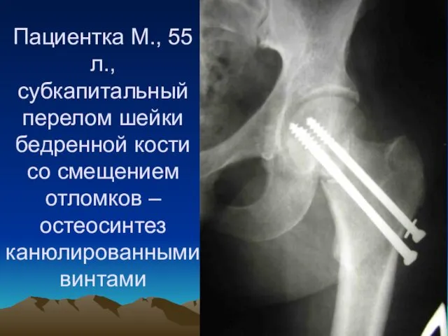 Пациентка М., 55 л., субкапитальный перелом шейки бедренной кости со смещением отломков – остеосинтез канюлированными винтами
