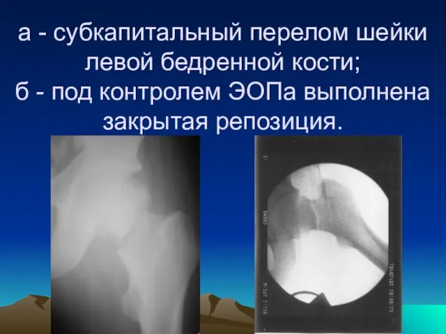 а - субкапитальный перелом шейки левой бедренной кости; б - под контролем ЭОПа выполнена закрытая репозиция.