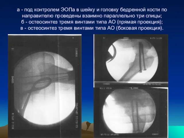 а - под контролем ЭОПа в шейку и головку бедренной
