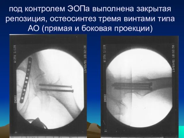 под контролем ЭОПа выполнена закрытая репозиция, остеосинтез тремя винтами типа АО (прямая и боковая проекции)