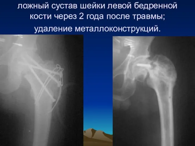 ложный сустав шейки левой бедренной кости через 2 года после травмы; удаление металлоконструкций.
