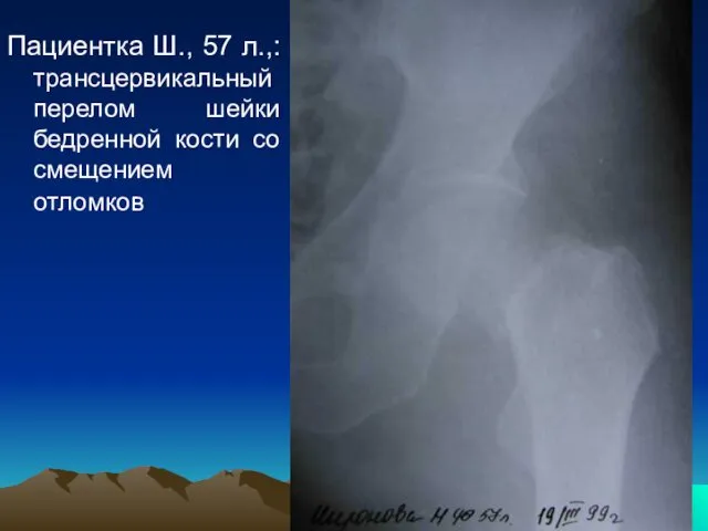 Пациентка Ш., 57 л.,: трансцервикальный перелом шейки бедренной кости со смещением отломков