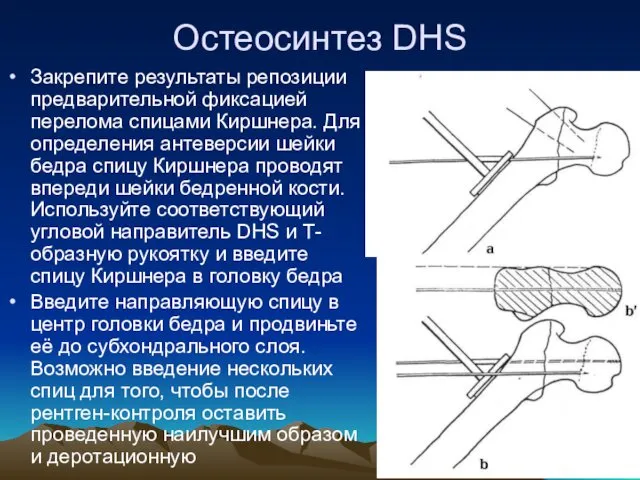 Остеосинтез DHS Закрепите результаты репозиции предварительной фиксацией перелома спицами Киршнера.