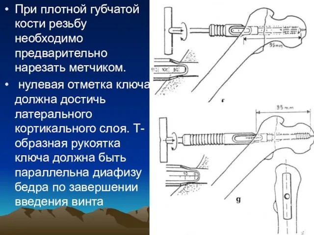 При плотной губчатой кости резьбу необходимо предварительно нарезать метчиком. нулевая