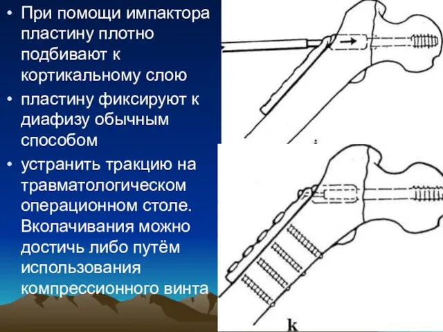 При помощи импактора пластину плотно подбивают к кортикальному слою пластину