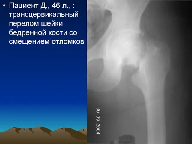 Пациент Д., 46 л., : трансцервикальный перелом шейки бедренной кости со смещением отломков