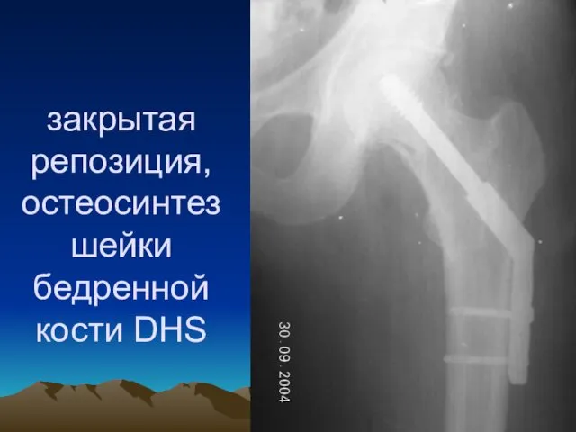 закрытая репозиция, остеосинтез шейки бедренной кости DHS