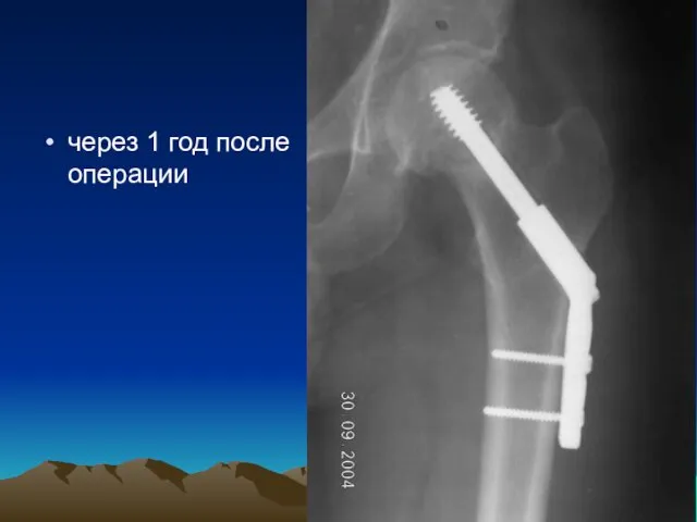 через 1 год после операции