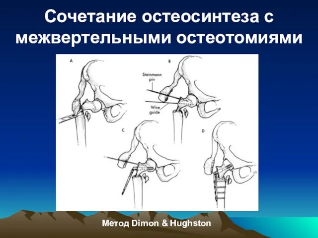 Сочетание остеосинтеза с межвертельными остеотомиями Метод Dimon & Hughston