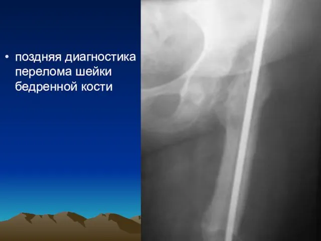 поздняя диагностика перелома шейки бедренной кости