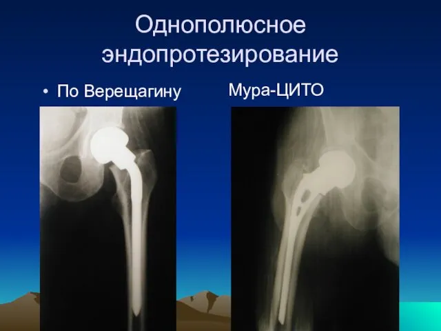 Однополюсное эндопротезирование По Верещагину Мура-ЦИТО