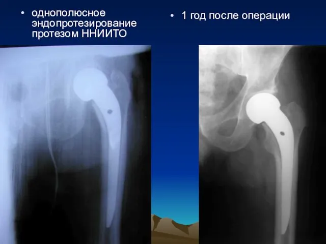 однополюсное эндопротезирование протезом ННИИТО 1 год после операции