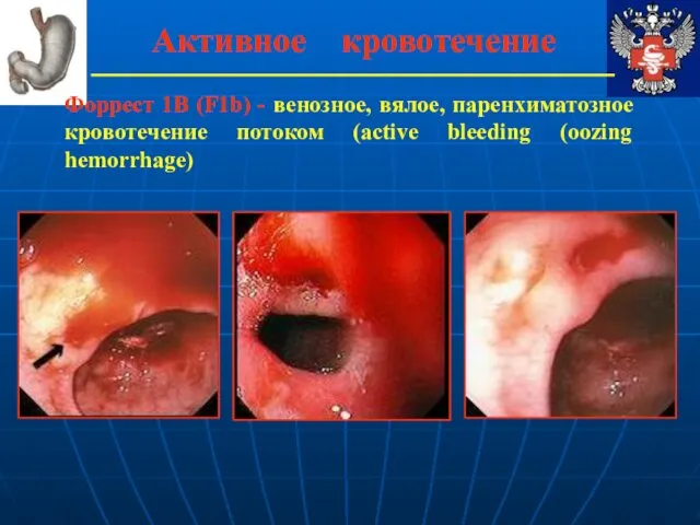 Активное кровотечение Форрест 1В (F1b) - венозное, вялое, паренхиматозное кровотечение потоком (active bleeding (oozing hemorrhage)