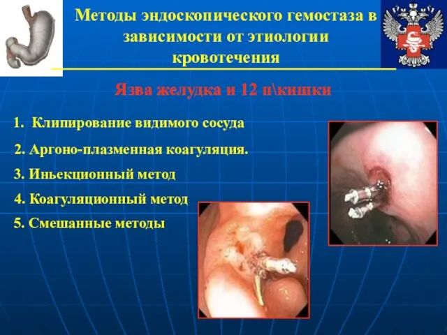 Методы эндоскопического гемостаза в зависимости от этиологии кровотечения Язва желудка