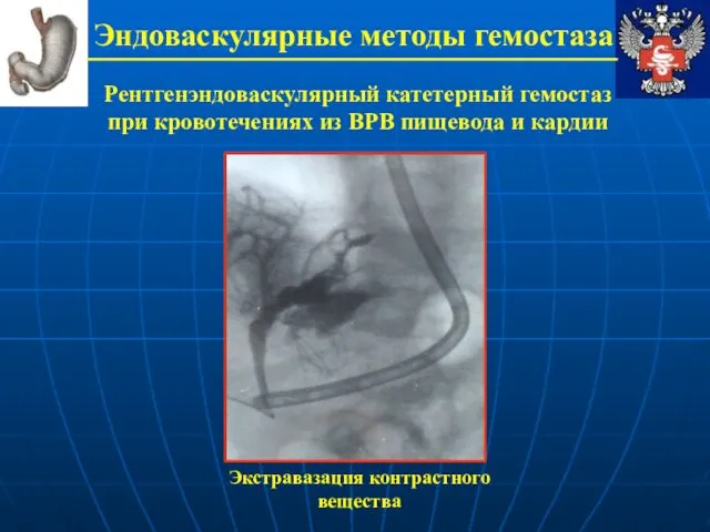 Эндоваскулярные методы гемостаза Рентгенэндоваскулярный катетерный гемостаз при кровотечениях из ВРВ пищевода и кардии Экстравазация контрастного вещества