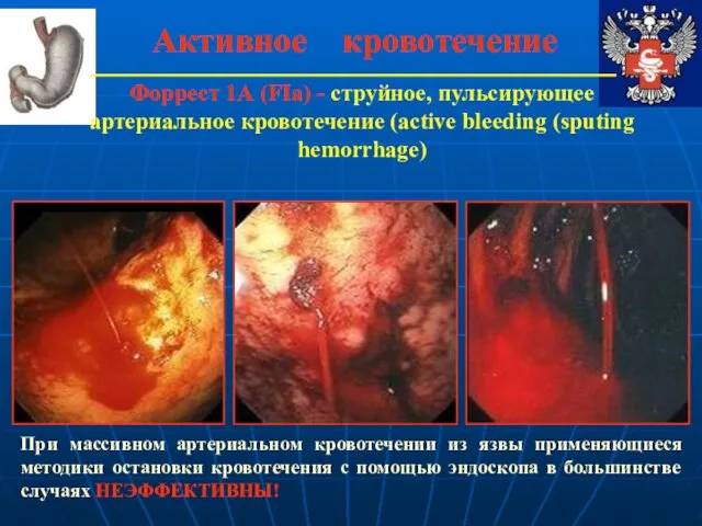 Активное кровотечение Форрест 1А (FIa) - струйное, пульсирующее артериальное кровотечение