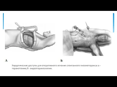Хирургические доступы для оперативного лечения спонтанного пневмоторакса: а – торакотомия; б - видеоторакоскопия.