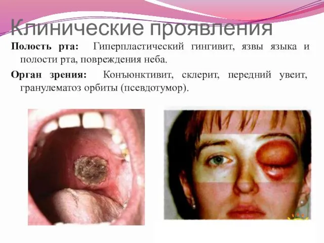 Клинические проявления Полость рта: Гиперпластический гингивит, язвы языка и полости