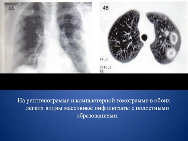 На рентгенограмме и компьютерной томограмме в обоих легких видны массивные инфильтраты с полостными образованиями.