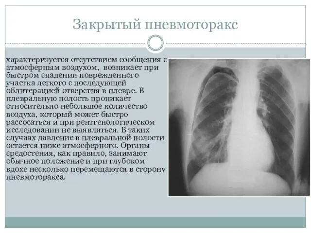 Закрытый пневмоторакс характеризуется отсутствием сообщения с атмосферным воздухом, возникает при