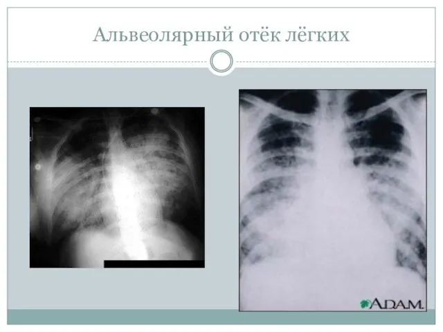 Альвеолярный отёк лёгких