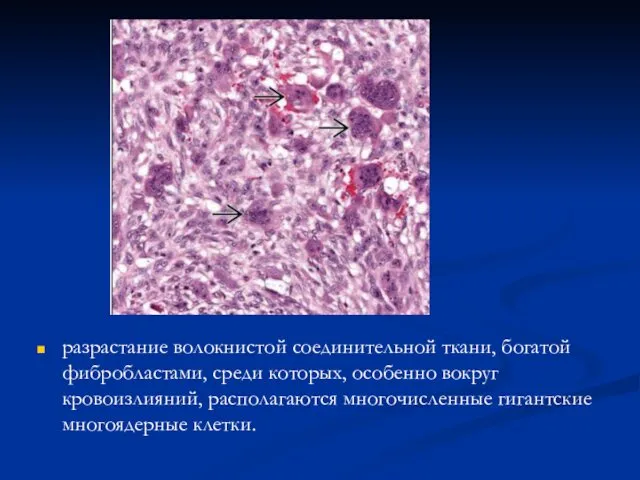 разрастание волокнистой соединительной ткани, богатой фибробластами, среди которых, особенно вокруг кровоизлияний, располагаются многочисленные гигантские многоядерные клетки.