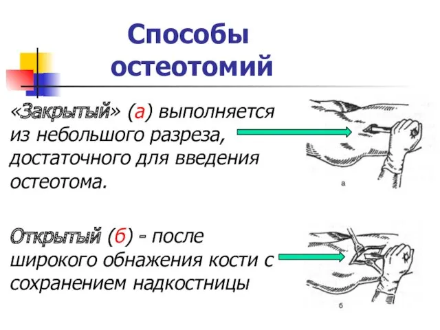 Способы остеотомий «Закрытый» (а) выполняется из небольшого разреза, достаточного для