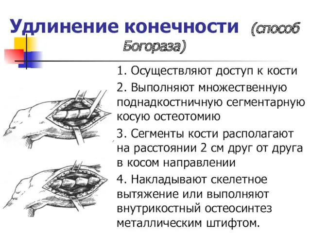 Удлинение конечности (способ Богораза) 1. Осуществляют доступ к кости 2.