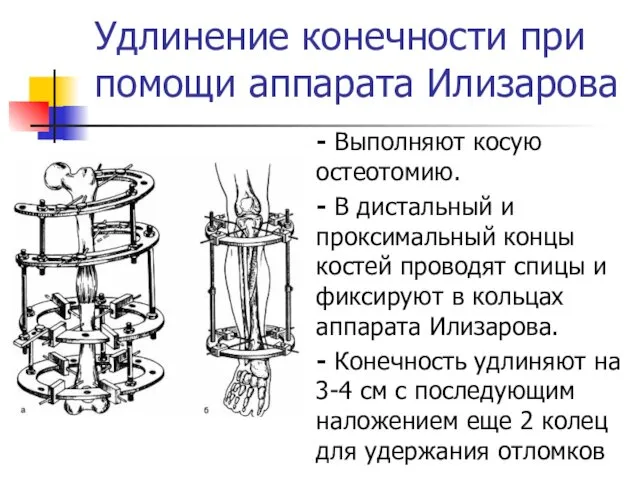 Удлинение конечности при помощи аппарата Илизарова - Выполняют косую остеотомию.