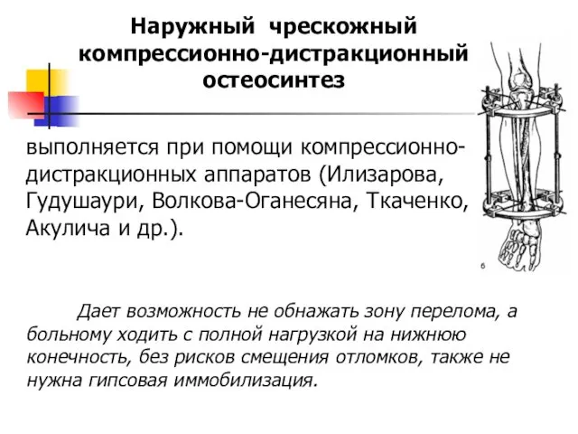 Наружный чрескожный компрессионно-дистракционный остеосинтез выполняется при помощи компрессионно-дистракционных аппаратов (Илизарова,