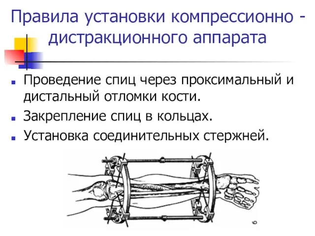 Правила установки компрессионно - дистракционного аппарата Проведение спиц через проксимальный