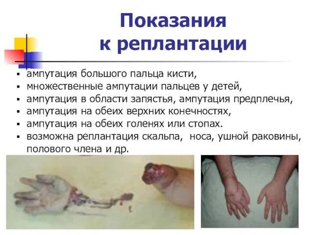 Показания к реплантации ампутация большого пальца кисти, множественные ампутации пальцев