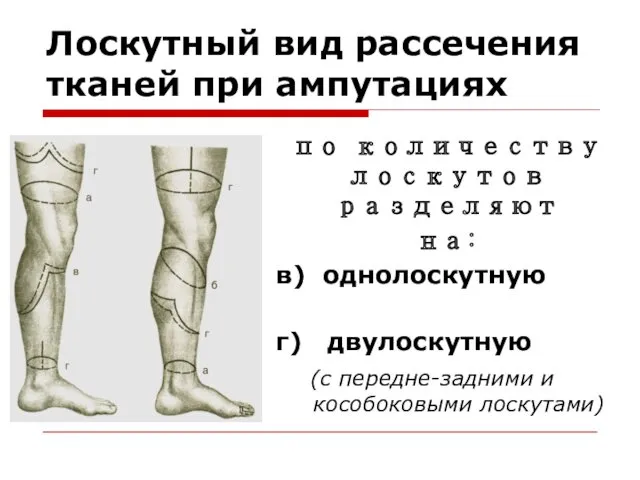 Лоскутный вид рассечения тканей при ампутациях по количеству лоскутов разделяют