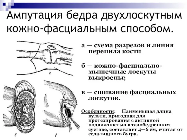 Ампутация бедра двухлоскутным кожно-фасциальным способом. а — схема разрезов и