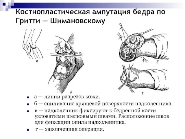 Костнопластическая ампутация бедра по Гритти — Шимановскому а — линии