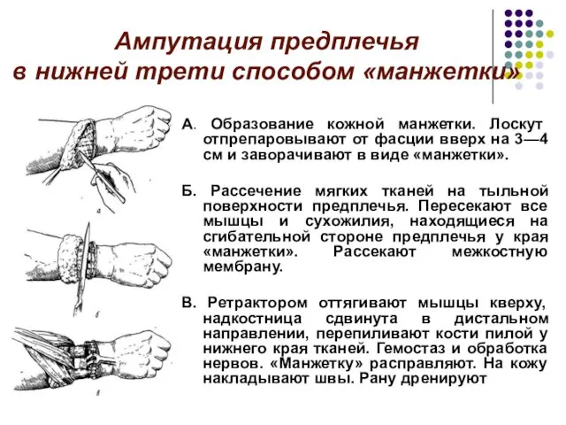 Ампутация предплечья в нижней трети способом «манжетки» А. Образование кожной