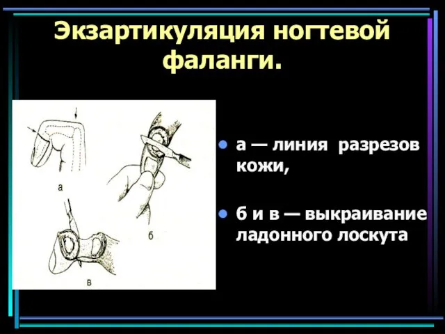 Экзартикуляция ногтевой фаланги. а — линия разрезов кожи, б и в — выкраивание ладонного лоскута