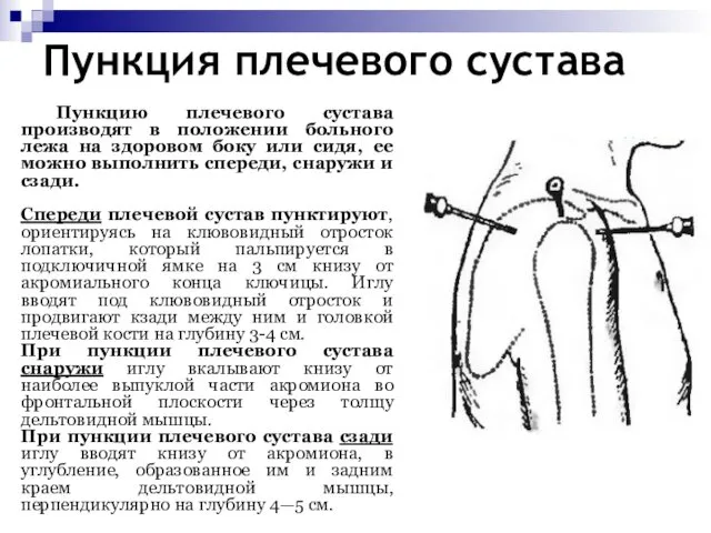 Пункция плечевого сустава Пункцию плечевого сустава производят в положении больного